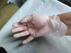 What is wax therapy?